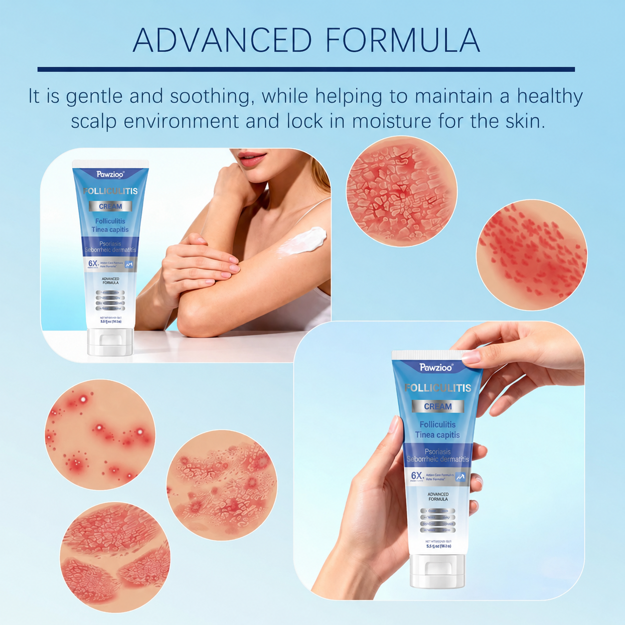 Folliculitis Soothing Cream for Folliculitis Scalp Face and Body