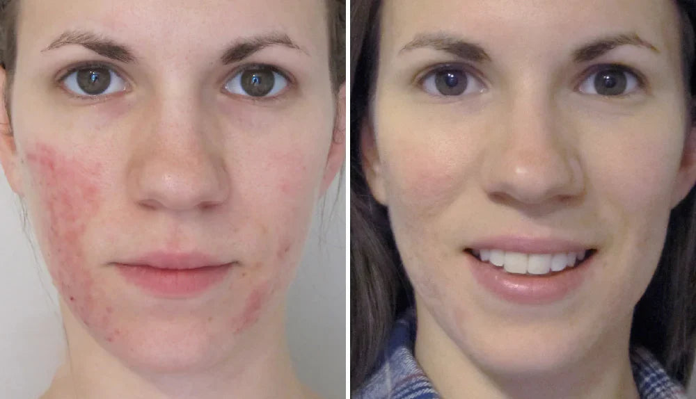 48H Redness Relief Cream – Calm & Restore Sensitive Skin