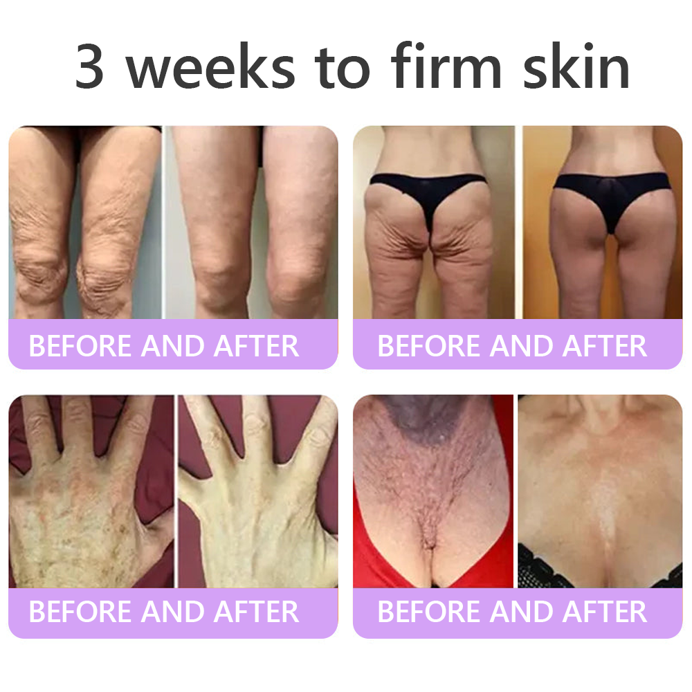 Vaxflite® PDRN Multi-Peptide Massaging Body Roller Cream- Anti-aging, Hydrating, Skin Firming & Lifting, Skin Repair, Even Tone, Acne and Dark Spot Treatment, Wart and Mole Removal, and Psoriasis Relief⭐