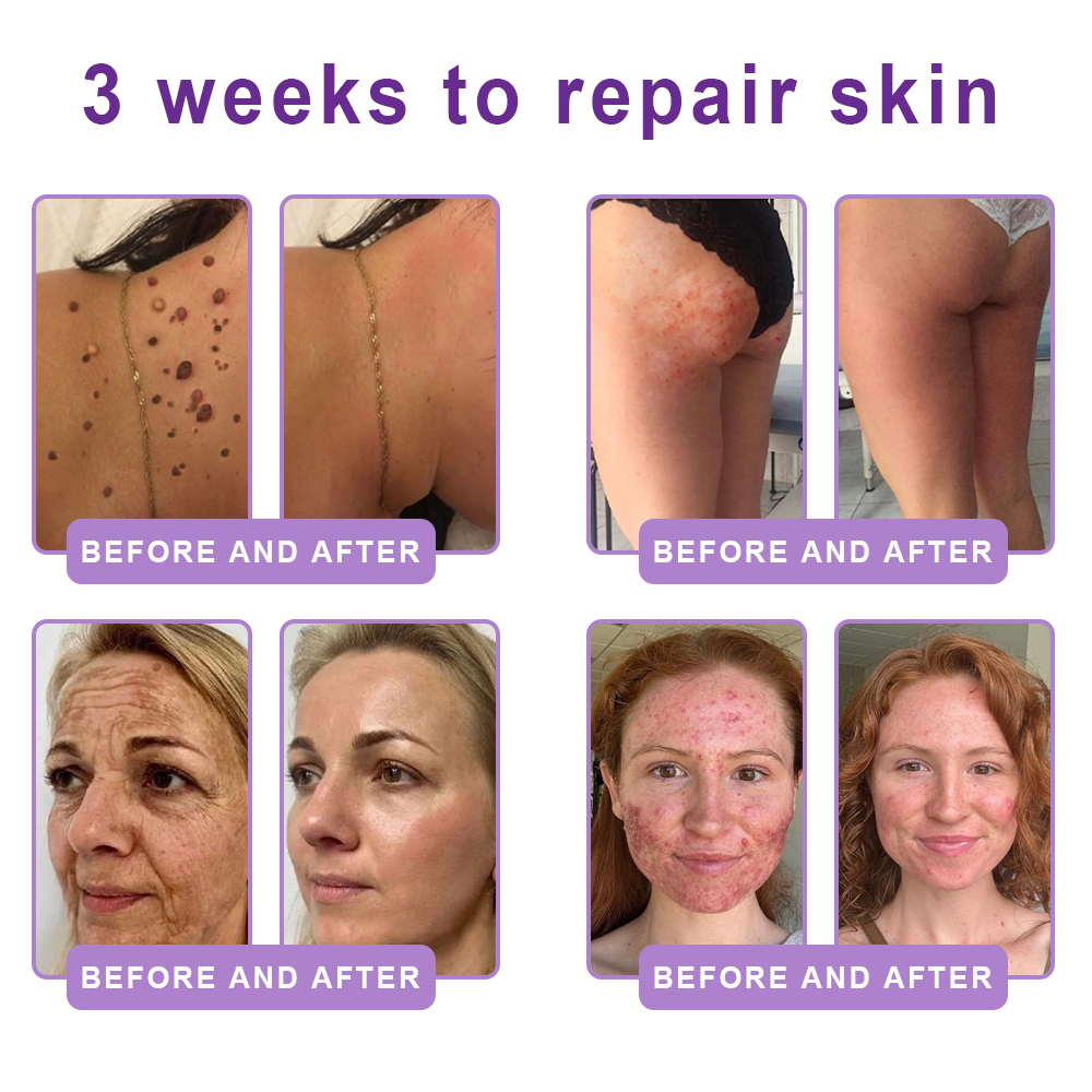 Vaxflite® PDRN Multi-Peptide Massaging Body Roller Cream- Anti-aging, Hydrating, Skin Firming & Lifting, Skin Repair, Even Tone, Acne and Dark Spot Treatment, Wart and Mole Removal, and Psoriasis Relief⭐