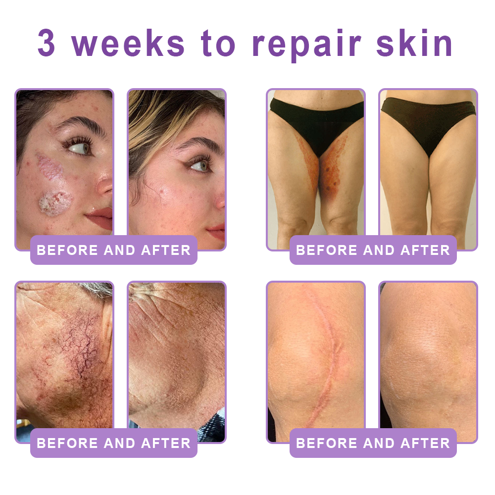 Vaxflite® PDRN Multi-Peptide Massaging Body Roller Cream- Anti-aging, Hydrating, Skin Firming & Lifting, Skin Repair, Even Tone, Acne and Dark Spot Treatment, Wart and Mole Removal, and Psoriasis Relief⭐