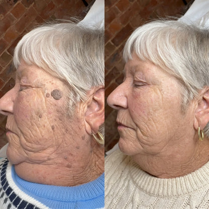 AQA® 𝟕-𝐃𝒂𝘆 𝐒𝗸𝐢𝐧 𝐓𝒂𝗴 𝐒𝐩𝙤𝐭 𝐄𝐫𝒂𝐬𝙚𝐫 Painless Scar-Free