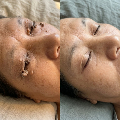 AQA® 𝟕-𝐃𝒂𝘆 𝐒𝗸𝐢𝐧 𝐓𝒂𝗴 𝐒𝐩𝙤𝐭 𝐄𝐫𝒂𝐬𝙚𝐫 Painless Scar-Free