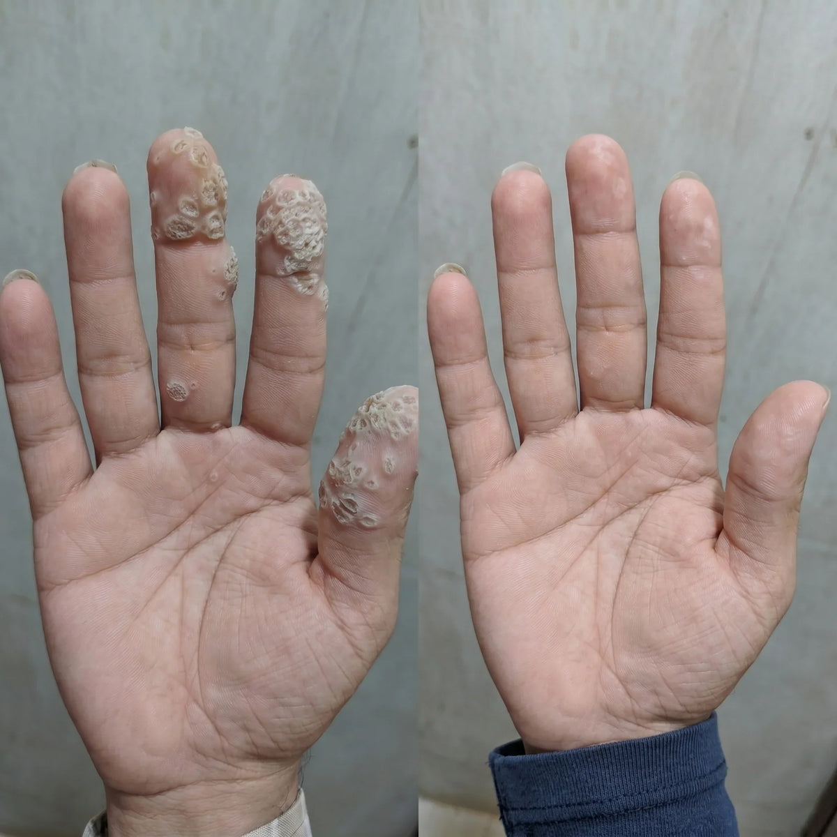 AQA® 𝟕-𝐃𝒂𝘆 𝐒𝗸𝐢𝐧 𝐓𝒂𝗴 𝐒𝐩𝙤𝐭 𝐄𝐫𝒂𝐬𝙚𝐫 Painless Scar-Free