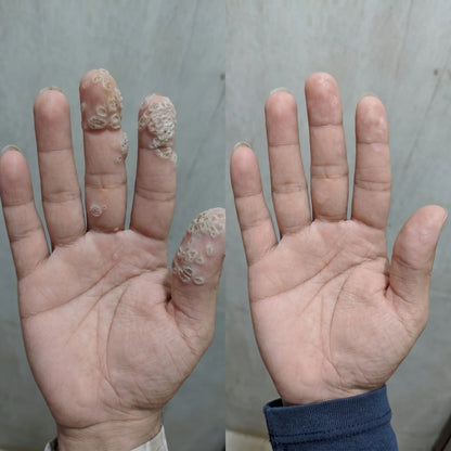 AQA® 𝟕-𝐃𝒂𝘆 𝐒𝗸𝐢𝐧 𝐓𝒂𝗴 𝐒𝐩𝙤𝐭 𝐄𝐫𝒂𝐬𝙚𝐫 Painless Scar-Free