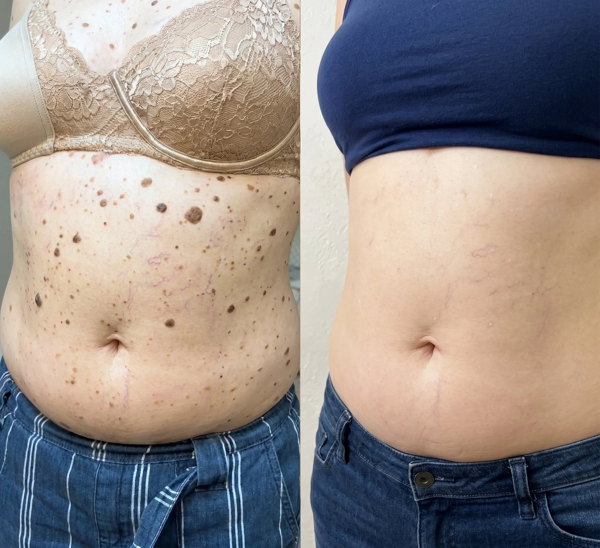 AQA® 𝟕-𝐃𝒂𝘆 𝐒𝗸𝐢𝐧 𝐓𝒂𝗴 𝐒𝐩𝙤𝐭 𝐄𝐫𝒂𝐬𝙚𝐫 Painless Scar-Free