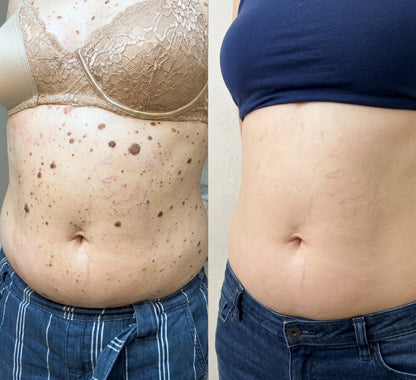 AQA® 𝟕-𝐃𝒂𝘆 𝐒𝗸𝐢𝐧 𝐓𝒂𝗴 𝐒𝐩𝙤𝐭 𝐄𝐫𝒂𝐬𝙚𝐫 Painless Scar-Free