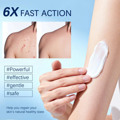 Folliculitis Soothing Cream for Folliculitis Scalp Face and Body